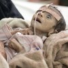  نجات-کودکان-۴۱۵-میلیون-کودک-در-مناطق-جنگی-بزرگ-می‌شوند - 85 هزار کودک یمنی قربانی سوء تغذیه